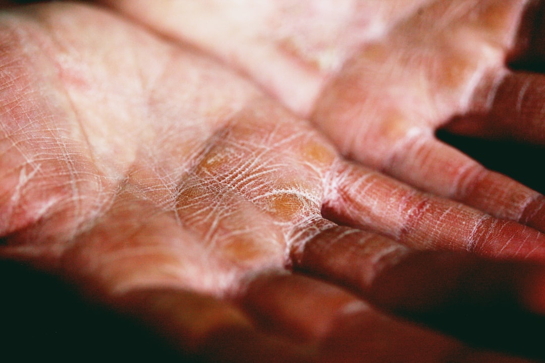 Allerjik Deri Hastalıkları: Dermatit, Ürtiker ve Tedavi Yöntemleri