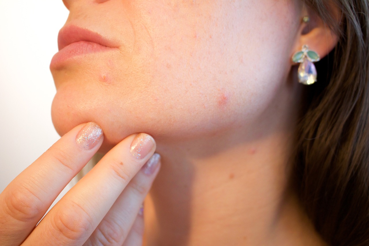 Dermatit ve Cilt Lekeleri: Lekeleri Giderme Yolları